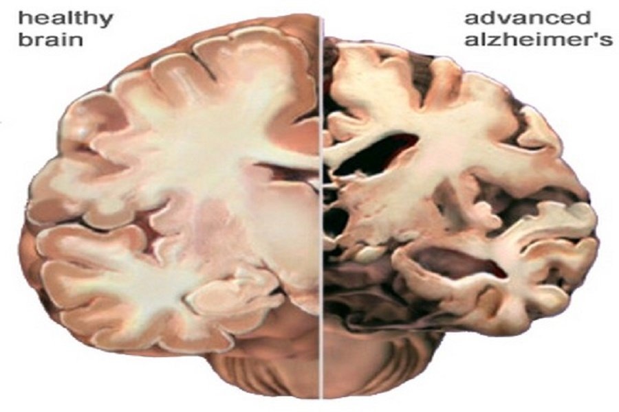 Image showing how different an alzheimers brain looks compared to a healthy brain.